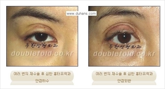 [두한성형외과 경쟁력 쌍꺼풀 재수술] - [두꺼운 라인을 교정하는 극한 재수술(Extreme Rroperation)] 관련 이미지 1