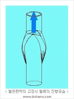 [두한성형외과 경쟁력 정맥류 치료] - [정맥류의 원인과 문제점, 정맥류 진단 방법] 관련 이미지 5