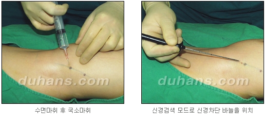 [두한성형외과 종아리 퇴축] - [종아리 퇴축술 재발 재수술] 관련 이미지 7