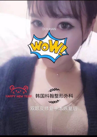 Best Place for Double Eyelid Revision Surgery, Duhan Plastic Surgery - Partial Incision Eye Revision Surgery image 50