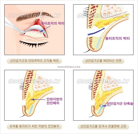 [두한성형외과 경쟁력 쌍꺼풀 재수술, 극한 눈재수술] - [안검하수 검사 및 수술방법 안내] 관련 이미지 6
