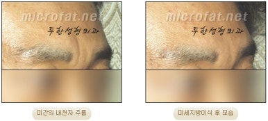 Duhan Plastic Surgery Wrinkle Improvement - Glabellar Horizontal Wrinkles, Glabellar Straight Wrinkles, Glabellar Wrinkle Surgery image 18