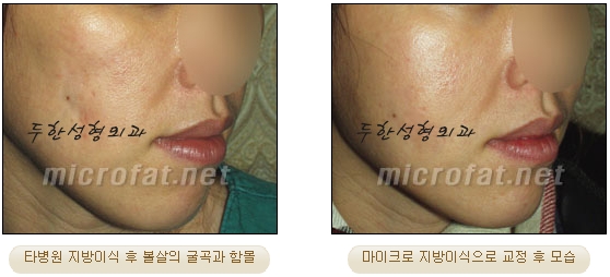 얼굴지방이식 두한성형외과 - 볼지방이식 관련 이미지 39