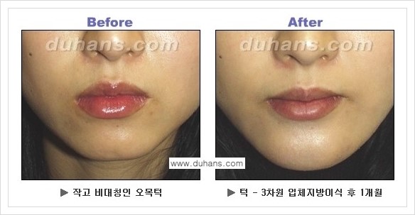 [두한성형외과 경쟁력 미세지방이식] - [아름다운 얼굴선 - 무턱, 오목턱, 비대칭턱 지방이식 안내] 관련 이미지 7