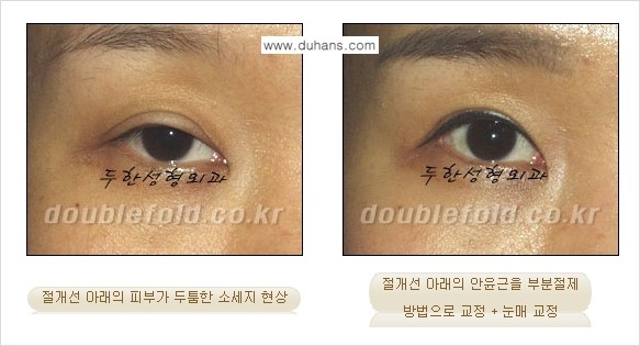 [두한성형외과 경쟁력 극한눈(쌍꺼풀)재수술] - [절개선 아래가 두툼한 소세지 쌍꺼풀 교정] 관련 이미지 7