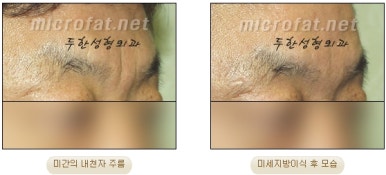 Duhan Plastic Surgery Wrinkle Improvement - Glabellar Horizontal Wrinkles, Glabellar Straight Wrinkles, Glabellar Wrinkle Surgery image 19