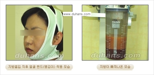 ​​​﻿[두한성형외과 경쟁력 간편지방흡입] - [볼살지방흡입, 턱선지방흡입 시술 과정의 안내] 관련 이미지 6