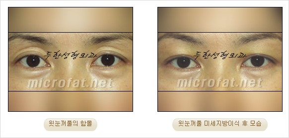 [두한성형외과 경쟁력 지방이식 리더] - [Col-fat(콜펫)지방이식, 3차원 입체지방이식, 2차원 평면지방이식] 관련 이미지 64