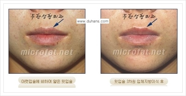 [두한성형외과 경쟁력 미세지방이식] - [입술 미세지방이식 안내 2.] 관련 이미지 5