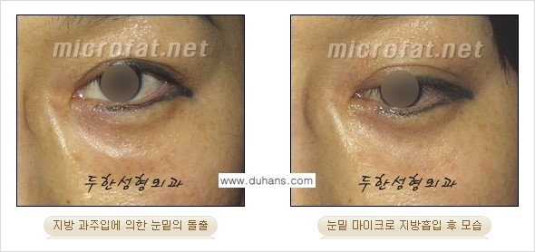 [두한성형외과 경쟁력 미세지방흡입] - [안면부의 안전한 미세지방흡입 안내] 관련 이미지 25