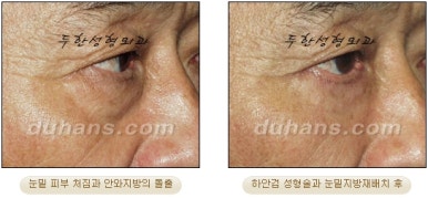 Blepharoplasty, Duhan Plastic Surgery - Upper and Lower Eyelids image 49