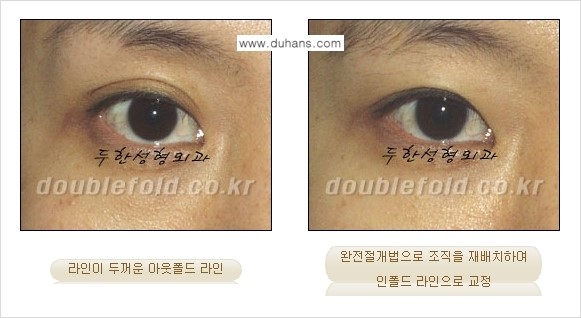 [두한성형외과 경쟁력 쌍꺼풀 재수술, 극한 눈재수술] - [심한 아웃폴드 라인을 인폴드 라인으로 교정 방법 안내] 관련 이미지 6