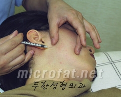 [두한성형외과 보톡스] - [사각턱 보톡스 시술 안내] 관련 이미지 10