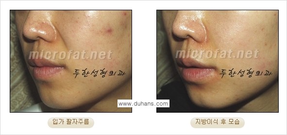 [두한성형외과의 경쟁력 있는 지방이식] - [입가주름, 팔자주름 미세지방이식 1.] 관련 이미지 11