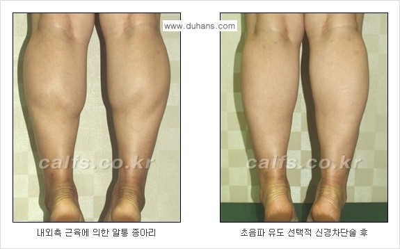 ​[두한성형외과와 날씬한 종아리 만들기!] - [간편하고 안전한 종아리 축소방법 ④] 관련 이미지 4