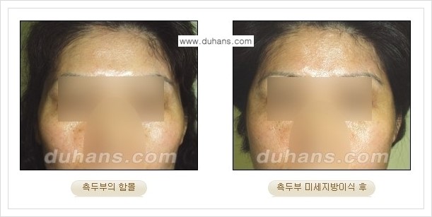 [두한성형외과 경쟁력 얼굴미세지방이식] - [볼살지방이식, 이마지방이식, 측두부지방이식 안내] 관련 이미지 4