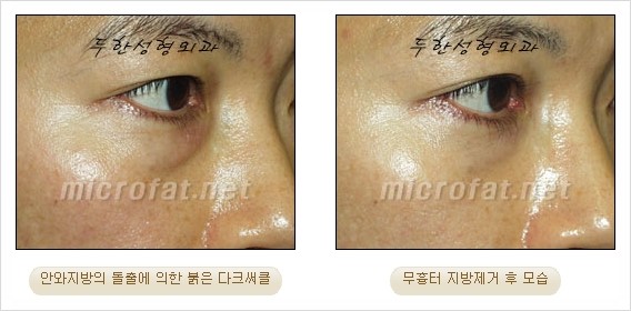 [두한성형외과 쌍커풀수술] - [눈성형 방법에 대한 자주하는 질문과 답변] 관련 이미지 175