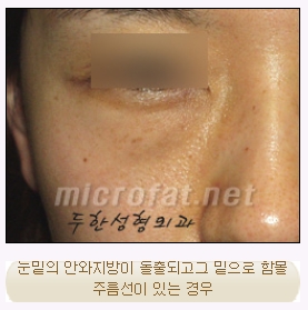 [두한성형외과 지방이식] - [다크써클, 눈​밑주름] 관련 이미지 41