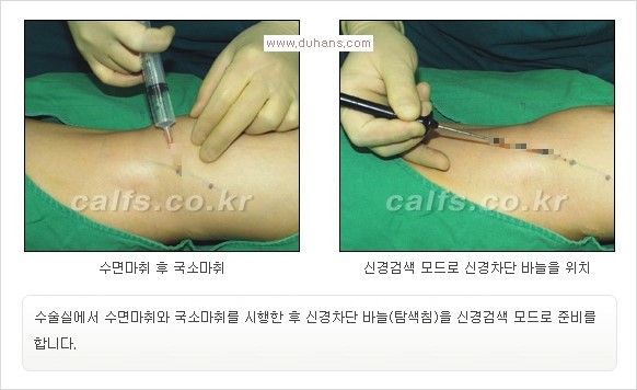 [두한성형외과 경쟁력 멀티종아리성형] -  [종아리 축소술의 여러 가지 종류] 관련 이미지 14