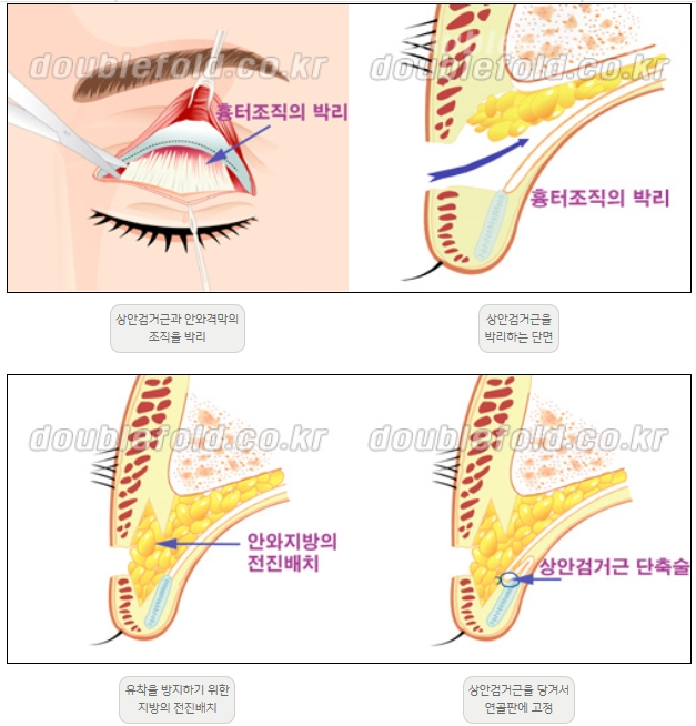 [Ptosis, Duhan Plastic Surgery] - [Sleepy-Looking Eyes, Ptosis Eye Correction] image 10
