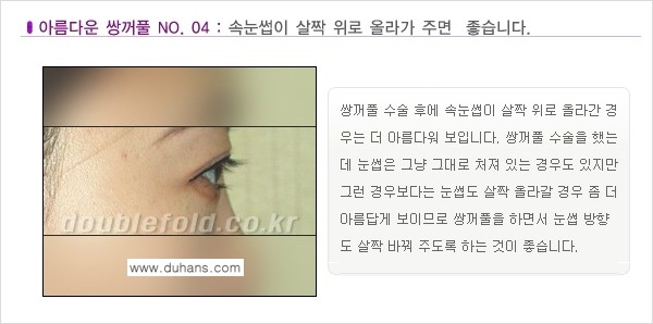 [두한성형외과 NO.1 눈성형] - [일반적인 기준의 아름다운 쌍꺼풀 모음] 관련 이미지 4