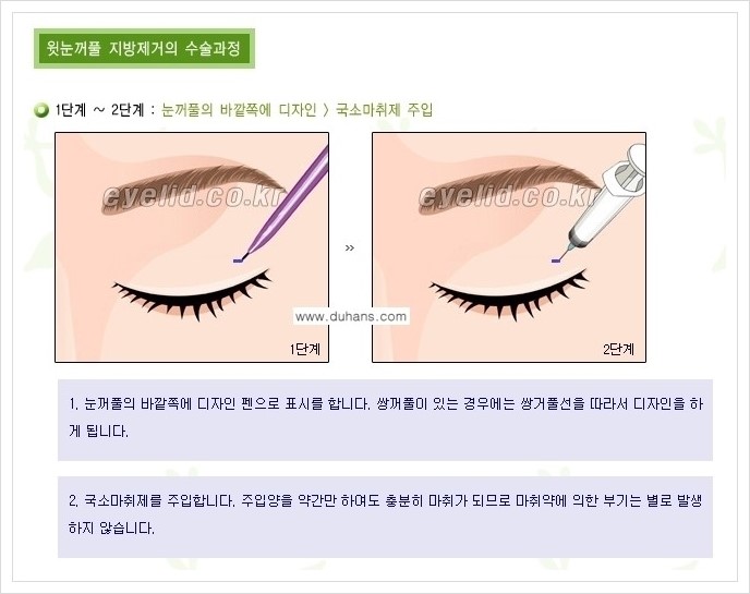 [두한성형외과 경쟁력 지방제거] - [윗눈꺼풀 지방제거, 아랫 눈꺼풀 지방제거  안내 1.] 관련 이미지 6