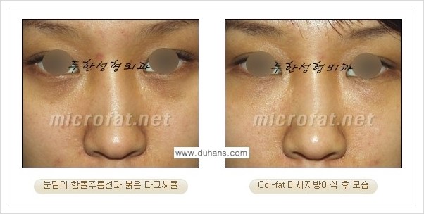 [두한성형외과 경쟁력 눈밑성형] - [눈밑 다크써클과 눈밑 함몰주름의 최적화 교정방법 안내] 관련 이미지 5