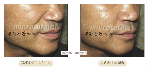 [두한성형외과 경쟁력 주름성형] - [입가와 팔자의 주름제거 지방이식 2.] 관련 이미지 6