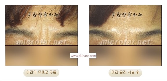 [두한성형외과 경쟁력 Quick성형] - [주름교정을 위한 필러 시술] 관련 이미지 11