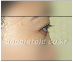 [Dohan Plastic Surgery Double Eyelid Surgery] - [Beautiful Double Eyelids] image 10