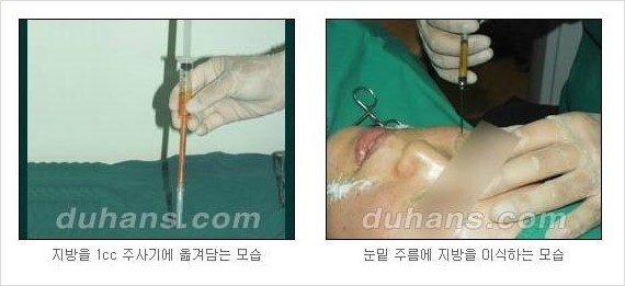 [두한성형외과 경쟁력 주름성형] - [간단하면서 자연스러운 주름제거 방법] 관련 이미지 22