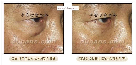 [두한성형외과 경쟁력 안검성형] - [눈밑주름 제거수술] 관련 이미지 13
