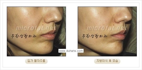 [두한성형외과 경쟁력 미세지방이식] - [입가주름, 팔자주름 교정 안내] 관련 이미지 10