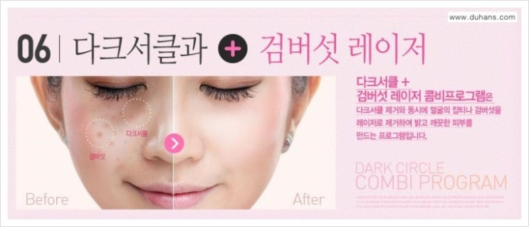 [두한성형외과 무한 경쟁력 다크써클 치료] - [다크써클 + 검버섯 레이저 콤비 프로그램] 관련 이미지 1