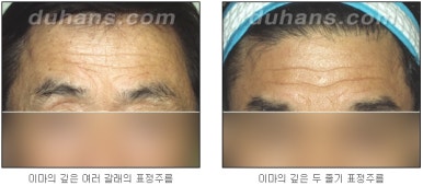 [Wrinkle Correction, Duhan Plastic Surgery] - [Wrinkle Botox, Wrinkle Filler, Wrinkle Fat Grafting] image 30