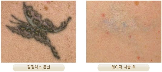 Duhan Plastic Surgery Laser Treatment - Mole Removal, Spot Removal, Melasma, Blemishes, Hyperpigmentation, Skin Tone Improvement, Elasticity Improvement, Skin Texture Improvement image 22