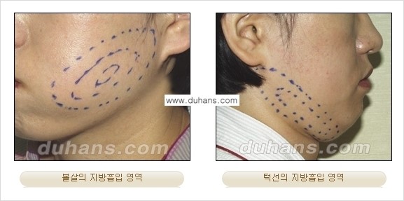 ​​​﻿[두한성형외과 경쟁력 간편지방흡입] - [볼살지방흡입, 턱선지방흡입 시술 과정의 안내] 관련 이미지 3