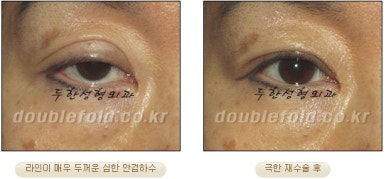 쌍꺼풀수술 두한성형외과 - 쌍커풀재수술의 문제점 관련 이미지 32
