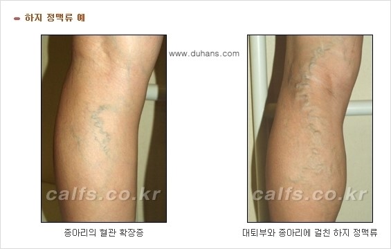 [두한성형외과 날씬한 종아리 만들기!] - [종아리 성형 안내 2.] 관련 이미지 9