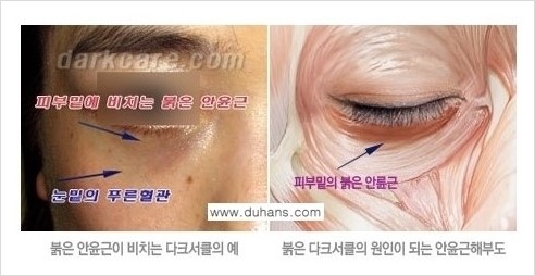 [두한성형외과 경쟁력 눈밑성형] - [눈밑 다크써클 원인과 눈밑 다크써클 치료 방법 안내] 관련 이미지 1