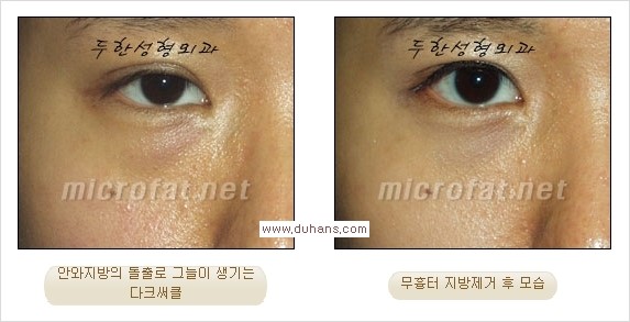 [두한성형외과 경쟁력 눈밑성형] - [과도한 눈밑지방제거의 부작용 후 눈밑지방재배치] 관련 이미지 14