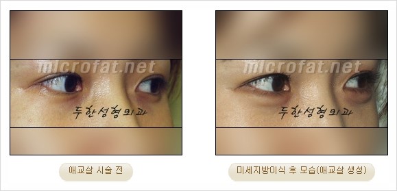 [두한성형외과 경쟁력 지방이식 리더] - [Col-fat(콜펫)지방이식, 3차원 입체지방이식, 2차원 평면지방이식] 관련 이미지 57