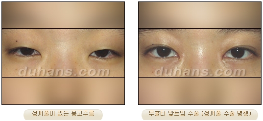 [Duhan Plastic Surgery Double Eyelid Surgery] - [Types of Double Eyelid Surgery] image 39