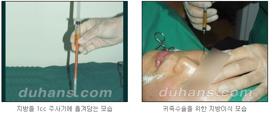 [두한성형외과 얼굴자가지방이식] - [귀족수술 입체 미세지방이식] 관련 이미지 10