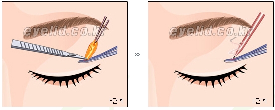 [두한성형외과 지방제거] - [눈두덩이지방제거, 눈밑지방제거] 관련 이미지 6
