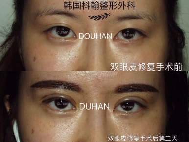 Best Place for Double Eyelid Revision Surgery, Duhan Plastic Surgery - Partial Incision Eye Revision Surgery image 48