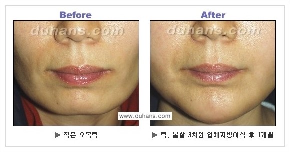 [두한성형외과 경쟁력 미세지방이식] - [아름다운 얼굴선 - 무턱, 오목턱, 비대칭턱 지방이식 안내] 관련 이미지 8