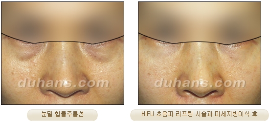 [Duhan Plastic Surgery Lift] - [Double Chin, Drooping Cheeks, Sagging Neck Skin, Wrinkle Improvement] image 27