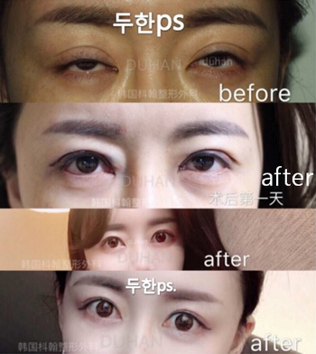 [Duhan Plastic Surgery Eyelid Surgery] - [Epicanthoplasty, Medial Canthoplasty] image 14