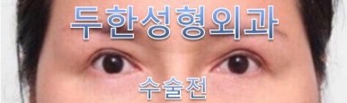 [Duhan Plastic Surgery Double Eyelid Revision] - [Reducing the Double Eyelid Line] image 18
